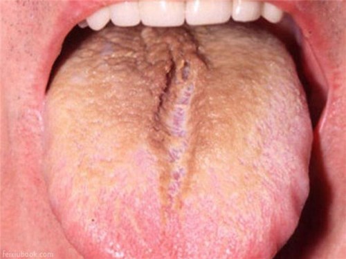 Các dấu hiệu ở lưỡi cảnh báo bệnh nghiêm trọng